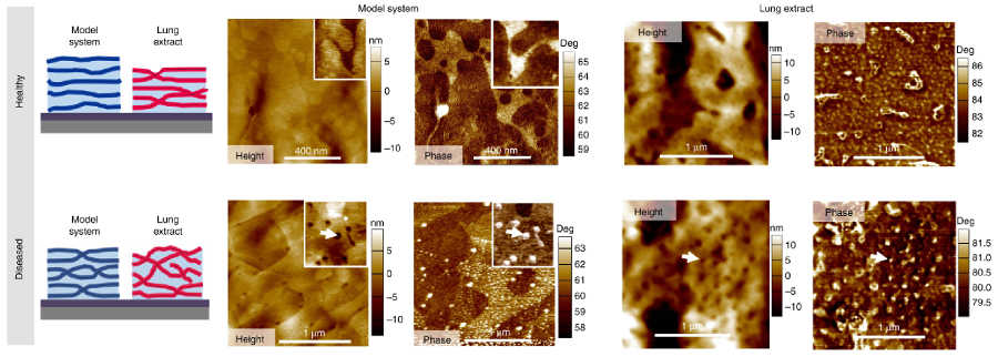 Conceptual diagrams of membrane morphology for healthy and diseased systems; topography and tapping mode phase images of a model system and a lung extract in healthy and diseased states