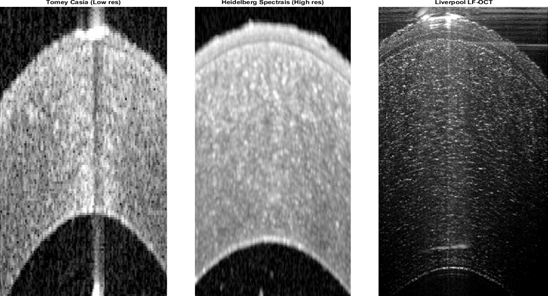 OCT images of a donor human cornea ex-vivo taken with two current commercial systems (SP-SS left, SP-SD middle) and Liverpool’s LF-OCT system (right). The ultra-high axial resolution of the system means that all 5 layers of the cornea and details of the stroma are better resolved than the current commercial systems [16].