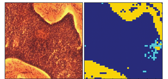 Comparison of the images acquired from a region of tissue showing, in a) the histopathology image acquired post Raman analysis, and b) the 2D pseudo-colour image derived from the Raman measurements carried out in-vitro