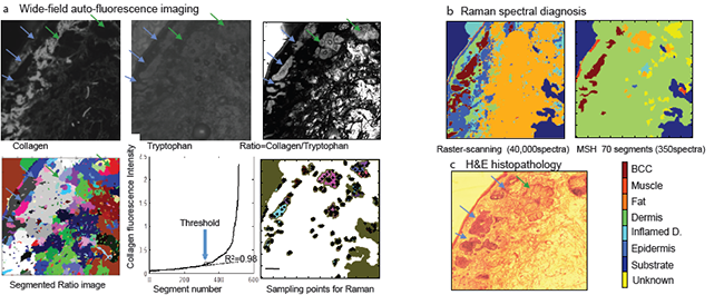 The ratio of wide-field auto-fluorescence intensity images corresponding to collagen (exc. 377 nm/em. 447 nm) and tryptophan(exc. 292 nm/em. 357 nm) was analysed by an image segmentation algorithm